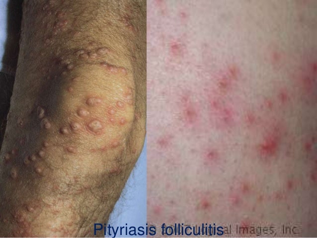 + oil face olive m mycoses Superficial cutaneous and