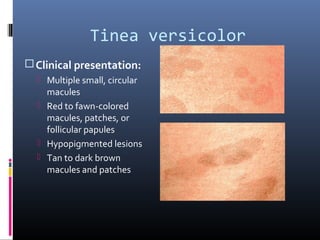 Tinea versicolor
 Clinical presentation:
   Multiple small, circular
    macules
   Red to fawn-colored
    macules, patches, or
    follicular papules
   Hypopigmented lesions
   Tan to dark brown
    macules and patches
 