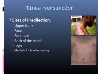 Tinea versicolor

 Sites of Predilection:
     Upper trunk
     Face
     Forehead
     Back of the hands
     Legs
   May itch if it is inflammatory
 