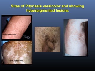 Sites of Pityriasis versicolor and showing
         hyperpigmented lesions
 