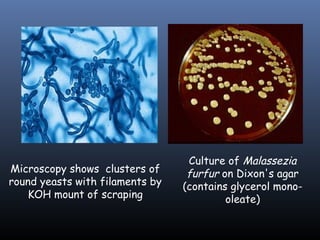 Culture of Malassezia
Microscopy shows clusters of      furfur on Dixon's agar
round yeasts with filaments by   (contains glycerol mono-
   KOH mount of scraping                  oleate)
 