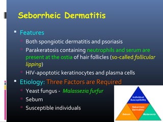 Seborrheic Dermatitis
 Features
   Both spongiotic dermatitis and psoriasis
   Parakeratosis containing neutrophils and serum are
    present at the ostia of hair follicles (so-called follicular
    lipping)
   HIV-apoptotic keratinocytes and plasma cells
 Etiology: Three Factors are Required
   Yeast fungus - Malassezia furfur
   Sebum
   Susceptible individuals
 