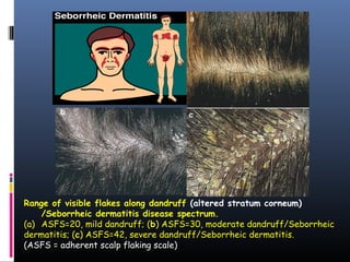 Range of visible flakes along dandruff (altered stratum corneum)
    /Seborrheic dermatitis disease spectrum.
(a) ASFS=20, mild dandruff; (b) ASFS=30, moderate dandruff/Seborrheic
dermatitis; (c) ASFS=42, severe dandruff/Seborrheic dermatitis.
(ASFS = adherent scalp flaking scale)
 