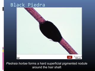 Black Piedra




Piedraia hortae forms a hard superficial pigmented nodule
                   around the hair shaft
 