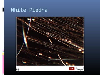 White Piedra
 