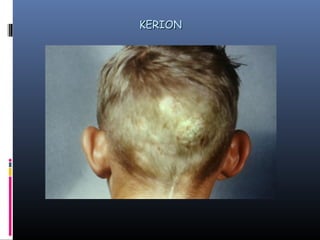 KERION
 