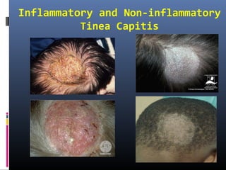 Inflammatory and Non-inflammatory
          Tinea Capitis
 