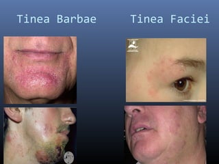 Tinea Barbae   Tinea Faciei
 