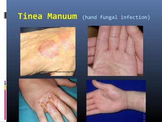 Tinea Manuum   (hand fungal infection)
 