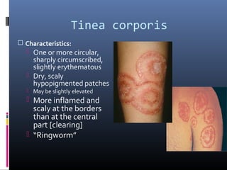 Tinea corporis
 Characteristics:
   One or more circular,
    sharply circumscribed,
    slightly erythematous
   Dry, scaly
    hypopigmented patches
   May be slightly elevated
   More inflamed and
    scaly at the borders
    than at the central
    part [clearing]
   “Ringworm”
 