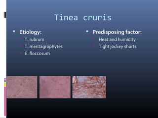 Tinea cruris
 Etiology:               Predisposing factor:
   T. rubrum               Heat and humidity
   T. mentagrophytes       Tight jockey shorts
   E. floccosum
 