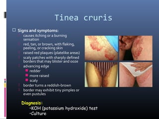 Tinea cruris
 Signs and symptoms:
   causes itching or a burning
      sensation
     red, tan, or brown, with flaking,
      peeling, or cracking skin
     raised red plaques (platelike areas)
     scaly patches with sharply defined
      borders that may blister and ooze
     advancing edge
        redder
        more raised
        scaly
     border turns a reddish-brown
     border may exhibit tiny pimples or
      even pustules

      Diagnosis:
         •KOH (potassium hydroxide) test
         •Culture
 