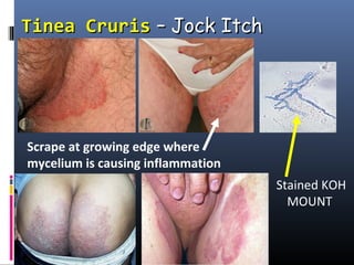 Tinea Cruris – Jock Itch




Scrape at growing edge where
mycelium is causing inflammation
                                   Stained KOH
                                     MOUNT
 