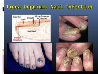 Tinea Unguium: Nail Infection
 