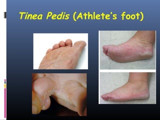 Tinea Pedis (Athlete’s foot)
 