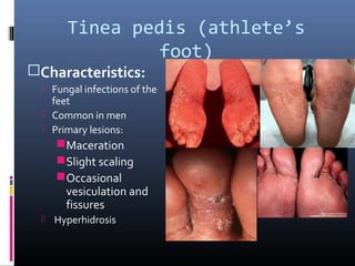 Tinea pedis (athlete’s
                foot)
Characteristics:
   Fungal infections of the
    feet
   Common in men
   Primary lesions:
      Maceration
      Slight scaling
      Occasional
       vesiculation and
       fissures
   Hyperhidrosis
 