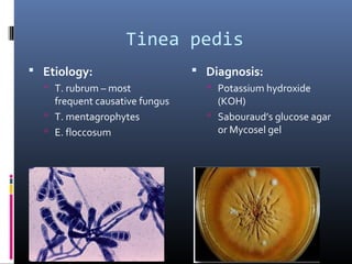 Tinea pedis
 Etiology:                      Diagnosis:
   T. rubrum – most               Potassium hydroxide
    frequent causative fungus       (KOH)
   T. mentagrophytes              Sabouraud’s glucose agar
   E. floccosum                    or Mycosel gel
 