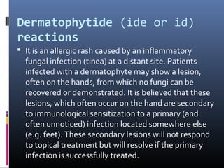 Dermatophytide (ide or id)
reactions
 It is an allergic rash caused by an inflammatory
  fungal infection (tinea) at a distant site. Patients
  infected with a dermatophyte may show a lesion,
  often on the hands, from which no fungi can be
  recovered or demonstrated. It is believed that these
  lesions, which often occur on the hand are secondary
  to immunological sensitization to a primary (and
  often unnoticed) infection located somewhere else
  (e.g. feet). These secondary lesions will not respond
  to topical treatment but will resolve if the primary
  infection is successfully treated.
 