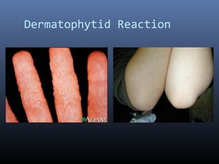 Dermatophytid Reaction
 