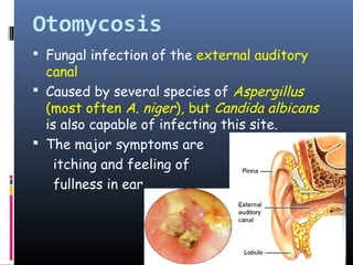 Otomycosis
 Fungal infection of the external auditory
  canal
 Caused by several species of Aspergillus
  (most often A. niger), but Candida albicans
  is also capable of infecting this site.
 The major symptoms are
    itching and feeling of
    fullness in ear
 