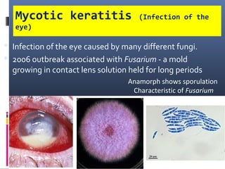Mycotic keratitis                 (Infection of the
   eye)

 Infection of the eye caused by many different fungi.
 2006 outbreak associated with Fusarium - a mold
  growing in contact lens solution held for long periods
                                  Anamorph shows sporulation
                                   Characteristic of Fusarium
 