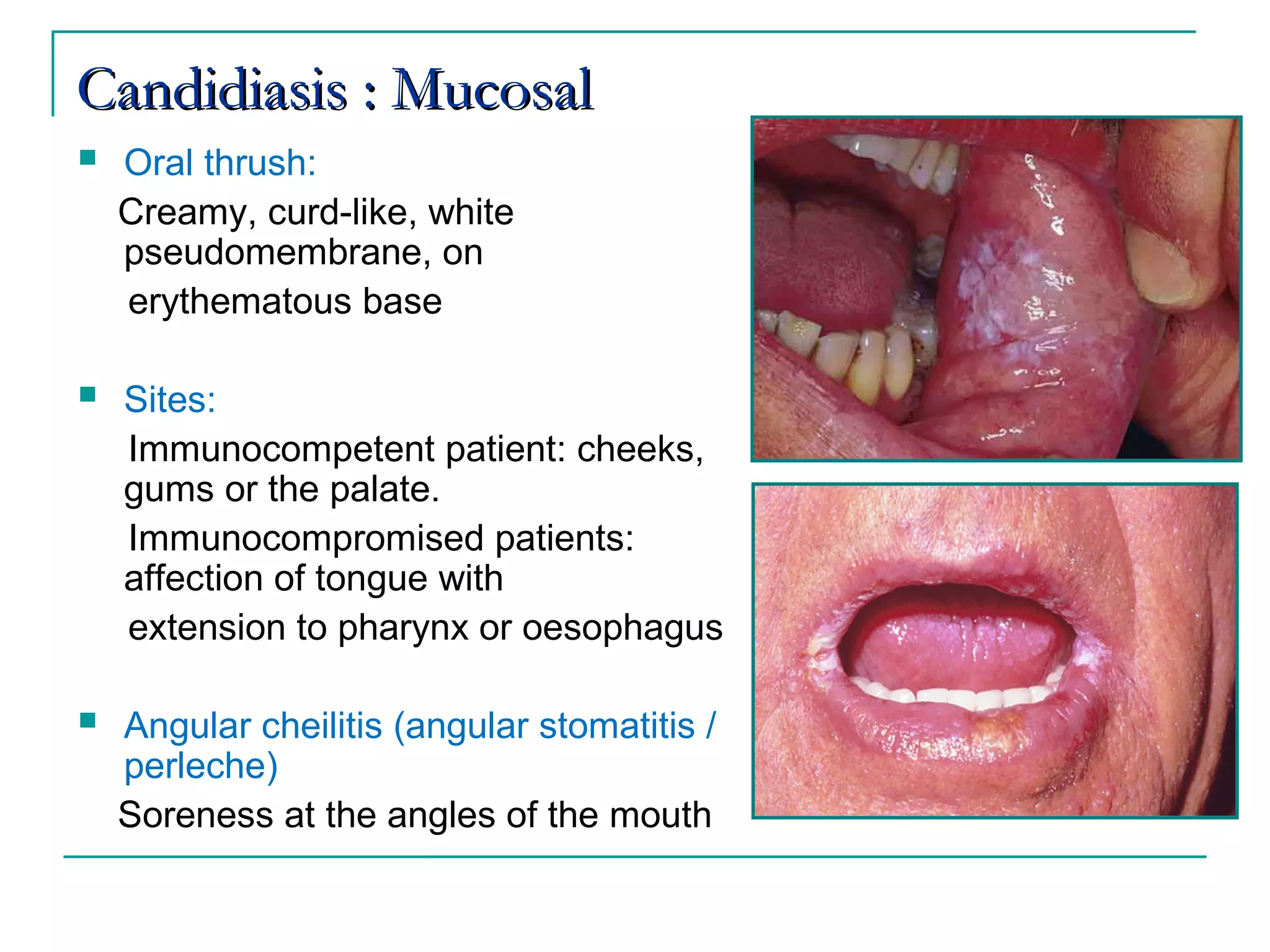Superficial fungal infections | PPT
