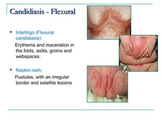 Superficial fungal infections | PPT