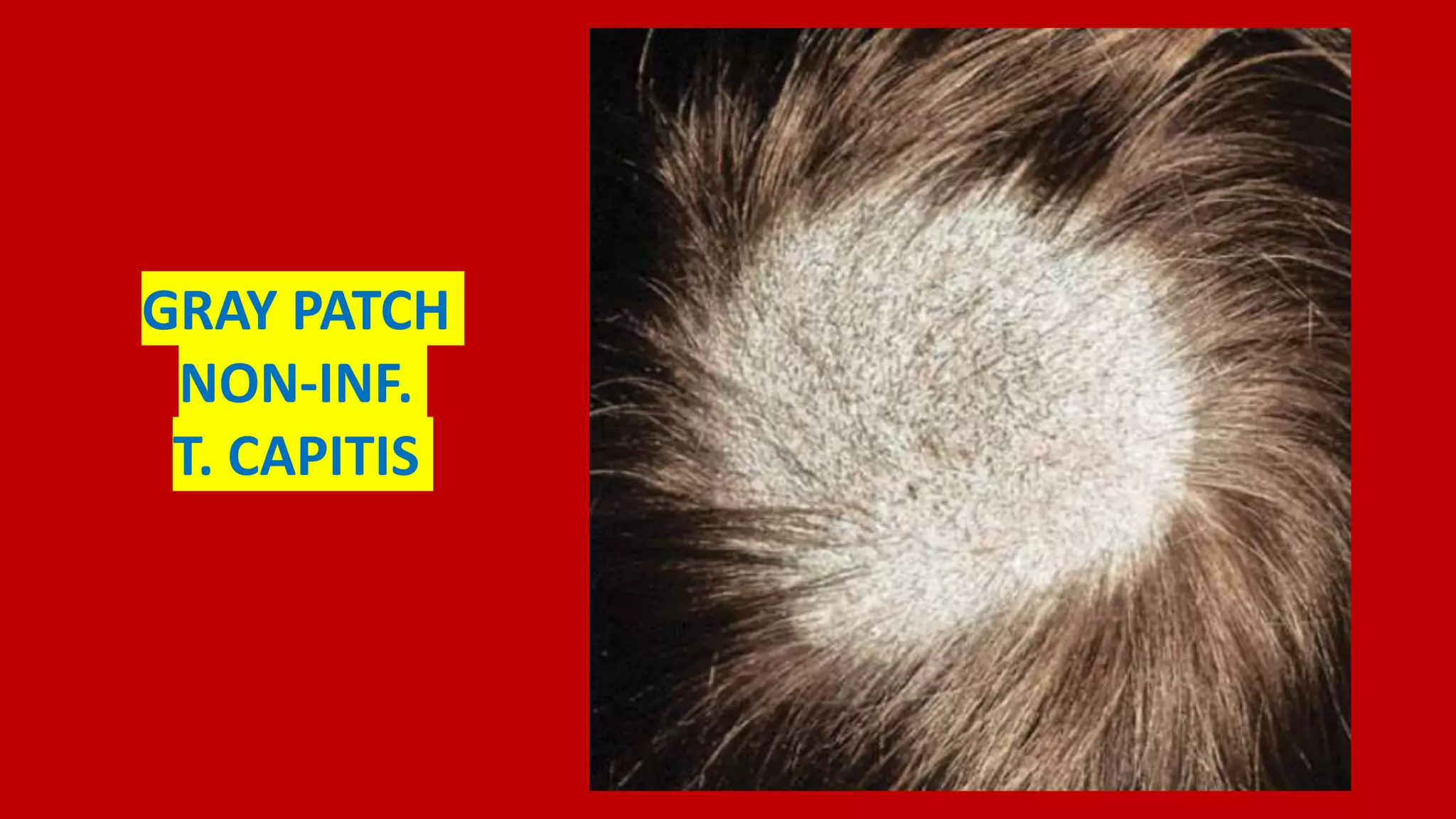 Gray Infection Superficial Fungal Infections | PPTX