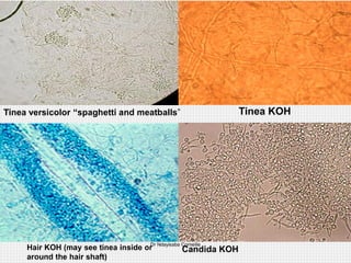 superficial-fungal-infections-pdf