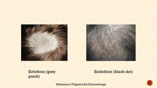 Superficial Fungal Infections (2).pptxlll | PPTX