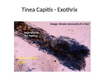 Comprehensive Overview of Superficial Fungal Infections and Their ...