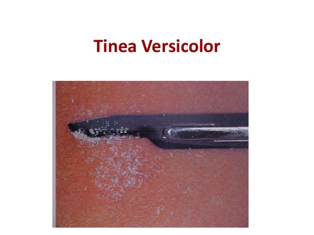 physical assessment of tinea versicolor an an Tinea versicolor is a condition characterized by a skin eruption on the trunk and proximal extremities the majority of tinea versicolor is caused by the fungus . physical assessment of tinea versicolor an an Tinea versicolor is a condition characterized by a skin eruption on the trunk and proximal extremities the majority of tinea versicolor is caused by the fungus .
