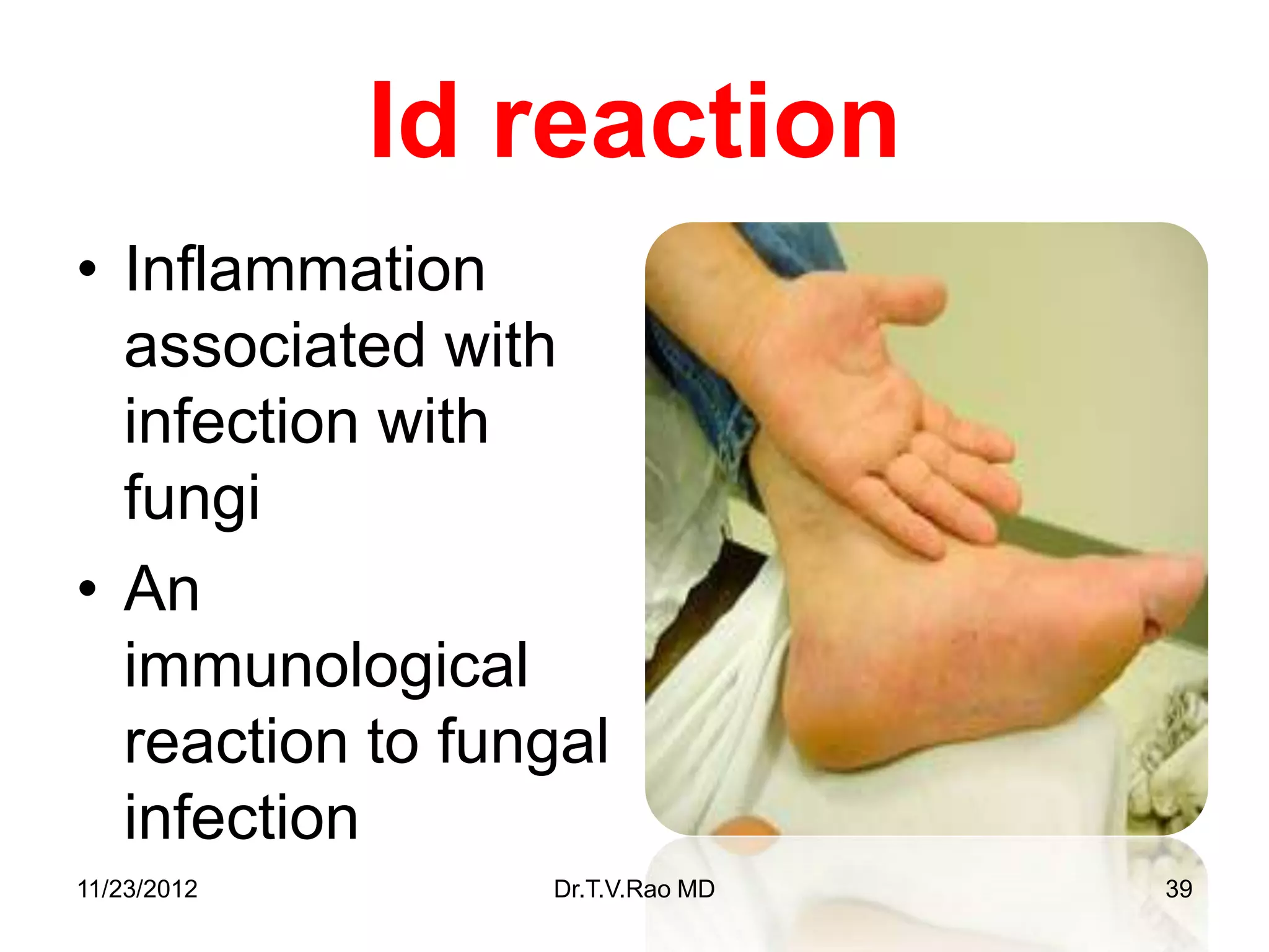 Superficial Fungal Infections | PPTX