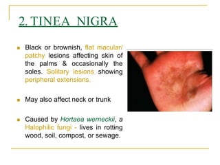 Tinea Nigra Clinical Presentation: History, Physical Examination,  Complications