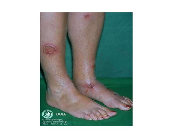 Superficial pyodermas by aseem | PPTX