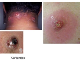 Back Carbuncle Superficial pyodermas by aseem | PPTX