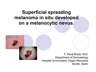 Superficial spreading melanoma in situ developed on a melanocytic nevus . F. Peral Rubio, M.D. Department of Dermatology Hospital Universitario Virgen Macarena Seville, Spain 