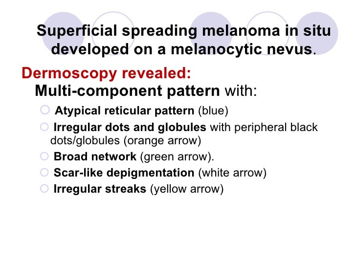 Superficial spreading melanoma in situ developed on a ...