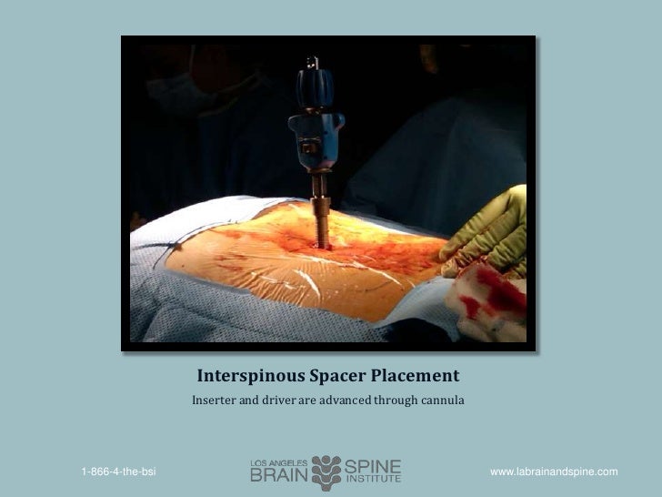 Treatment of Moderate Lumbar Spinal Stenosis with the Superion™ Inter…
