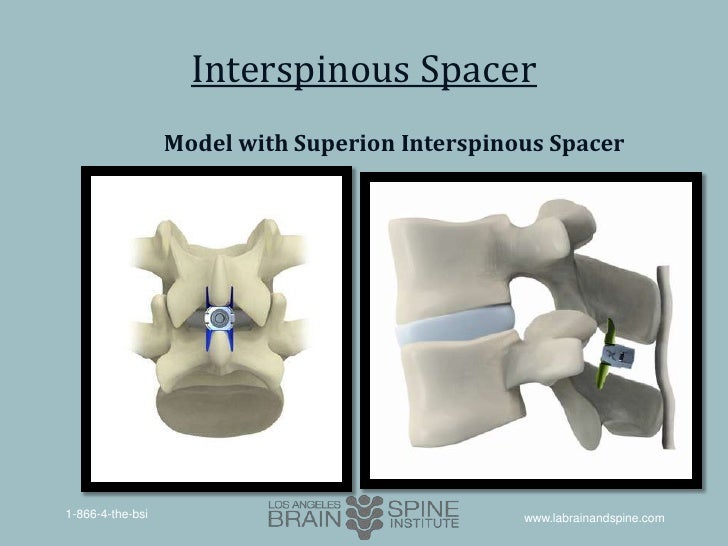Treatment of Moderate Lumbar Spinal Stenosis with the Superion™ Inter…