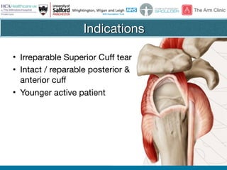 @thearmclinic
Indications
• Irreparable Superior Cuff tear

• Intact / reparable posterior &
anterior cuff

• Younger active patient
 