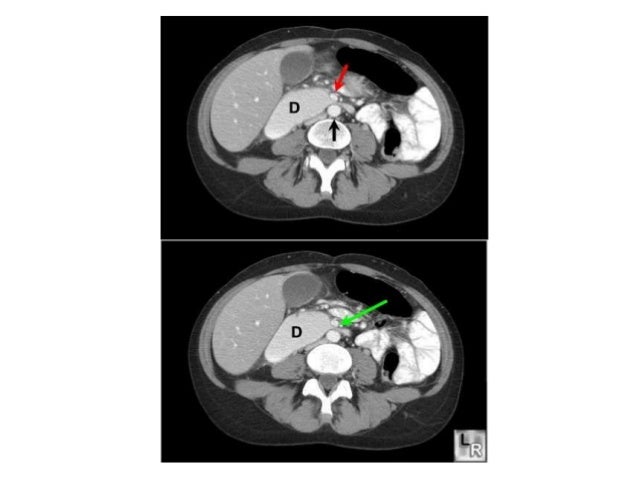 Superior Mesenteric Artery Syndrome Superior Mesenteric Artery Syndrome
