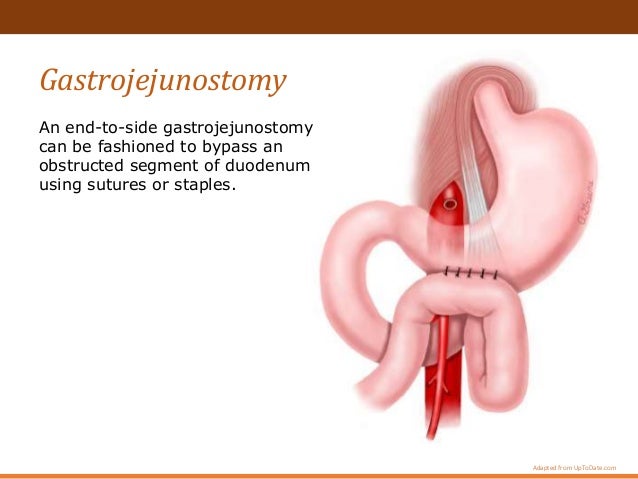 Superior Mesenteric Artery Syndrome Superior Mesenteric Artery Syndrome