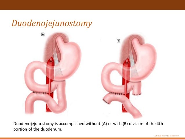 Superior Mesenteric Artery Syndrome Superior Mesenteric Artery Syndrome