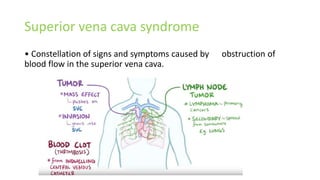 Svc. Sign Superior vena cava | PPTX