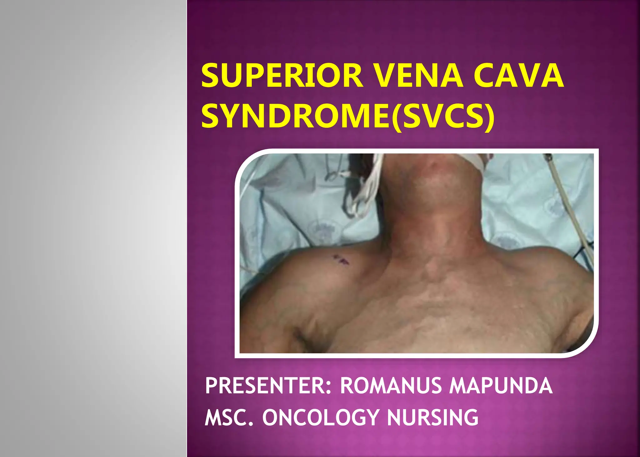Svc. Sign Superior Vena Cava Syndrome Early Signs