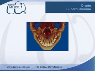www.dentometric.com Dr. Enrique Sierra Rosales
Diente
Supernumerario
 