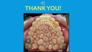 Supernumerary teeth fifth-year second semester