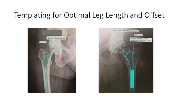 Super Path Hip Replacement