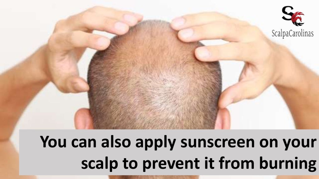Super Useful Ways to Avoid Sunburn on a Bald Head